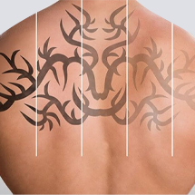 Men Laser tattoo removal