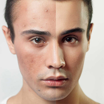 Men Acne & Acne scar solutions